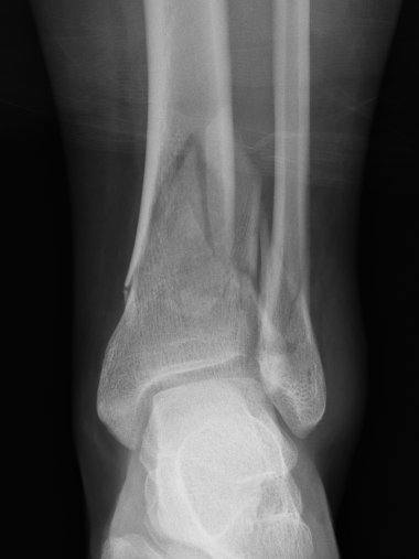 Distal tibia plate